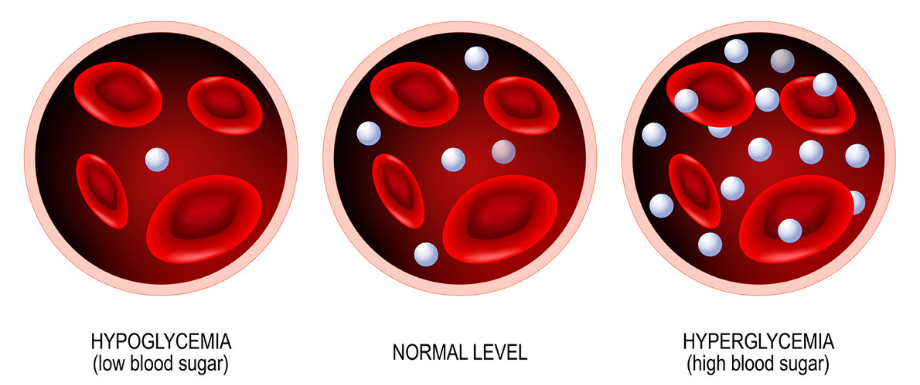 All about Hyperglycemia